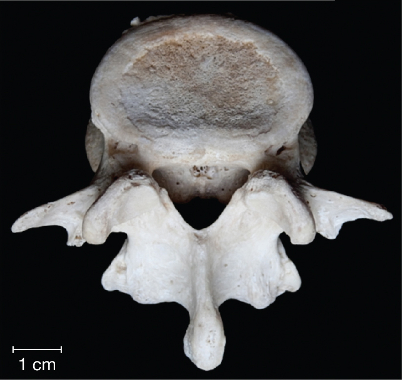 A photo shows a vertebra with an irregular shape.