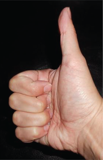 The dominant trait is straight thumb.