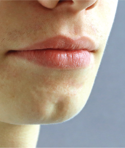 The dominant trait is cleft chin.