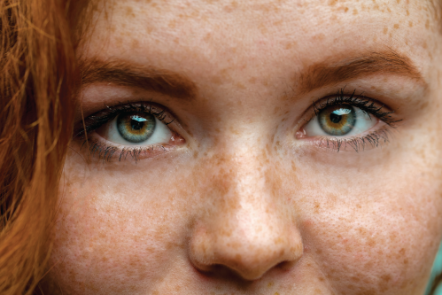 The dominant trait is freckles.