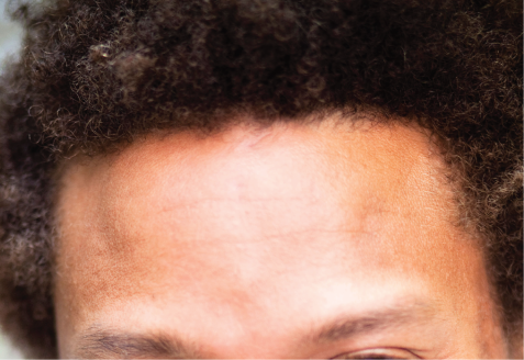 The recessive trait is straight peak.