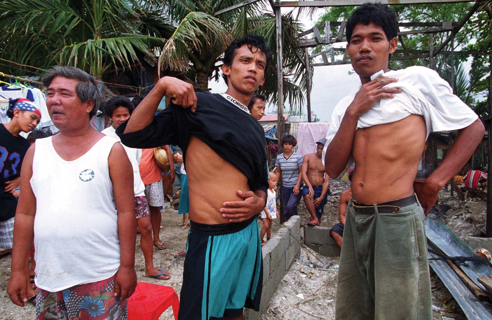 A man stands beside two young Filipino men holding up their T-shirts to show scars on their abdomens.