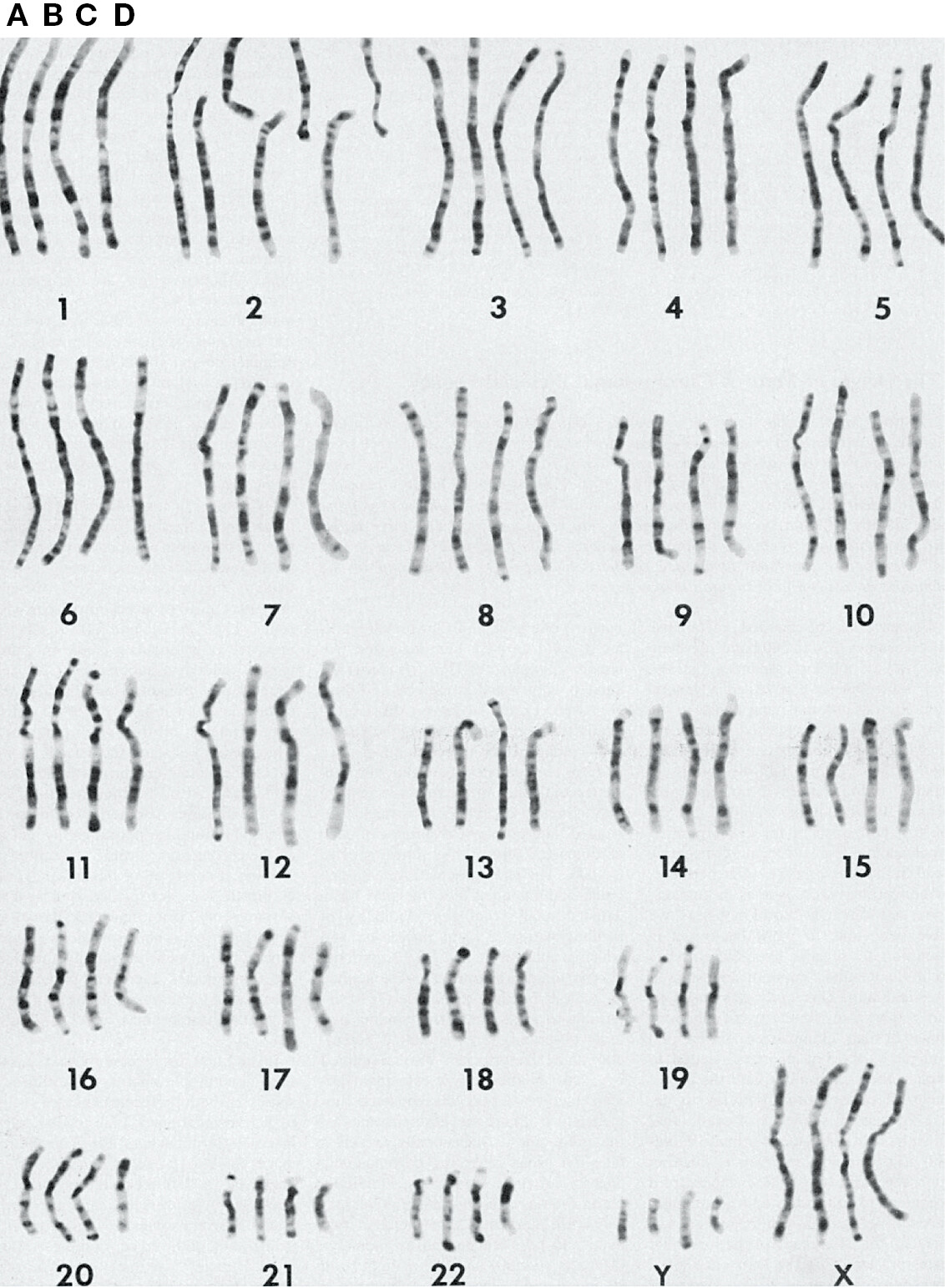 Chromosomes in groups labeled one through 22 as well as X and Y are shown.