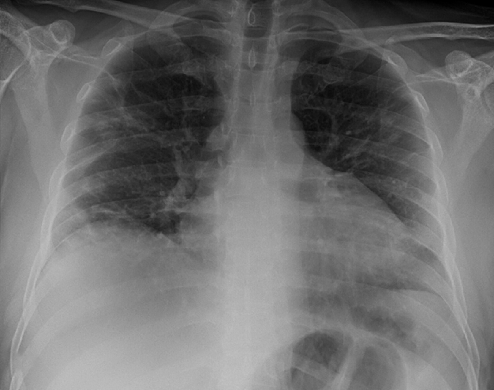 C T scan of lungs injured by C O V I D 19.