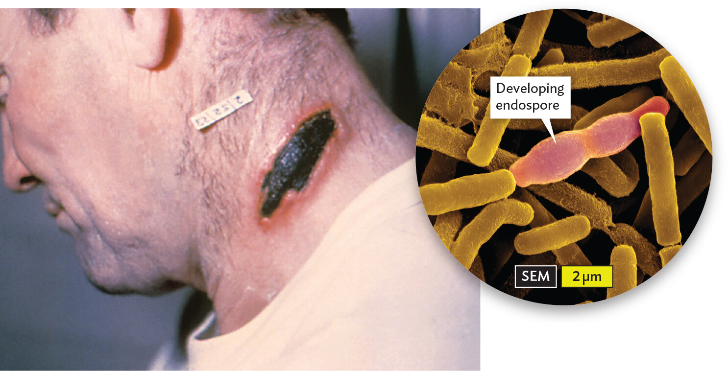 A photo of a patient infected by cutaneous anthrax and a micrograph of Bacillus anthracis.