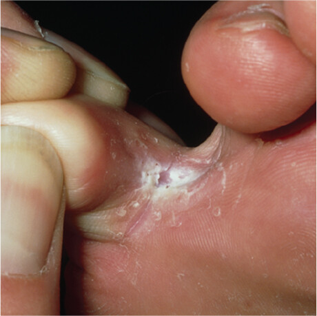 A photo of an athlete’s foot infection in the crease between two toes.