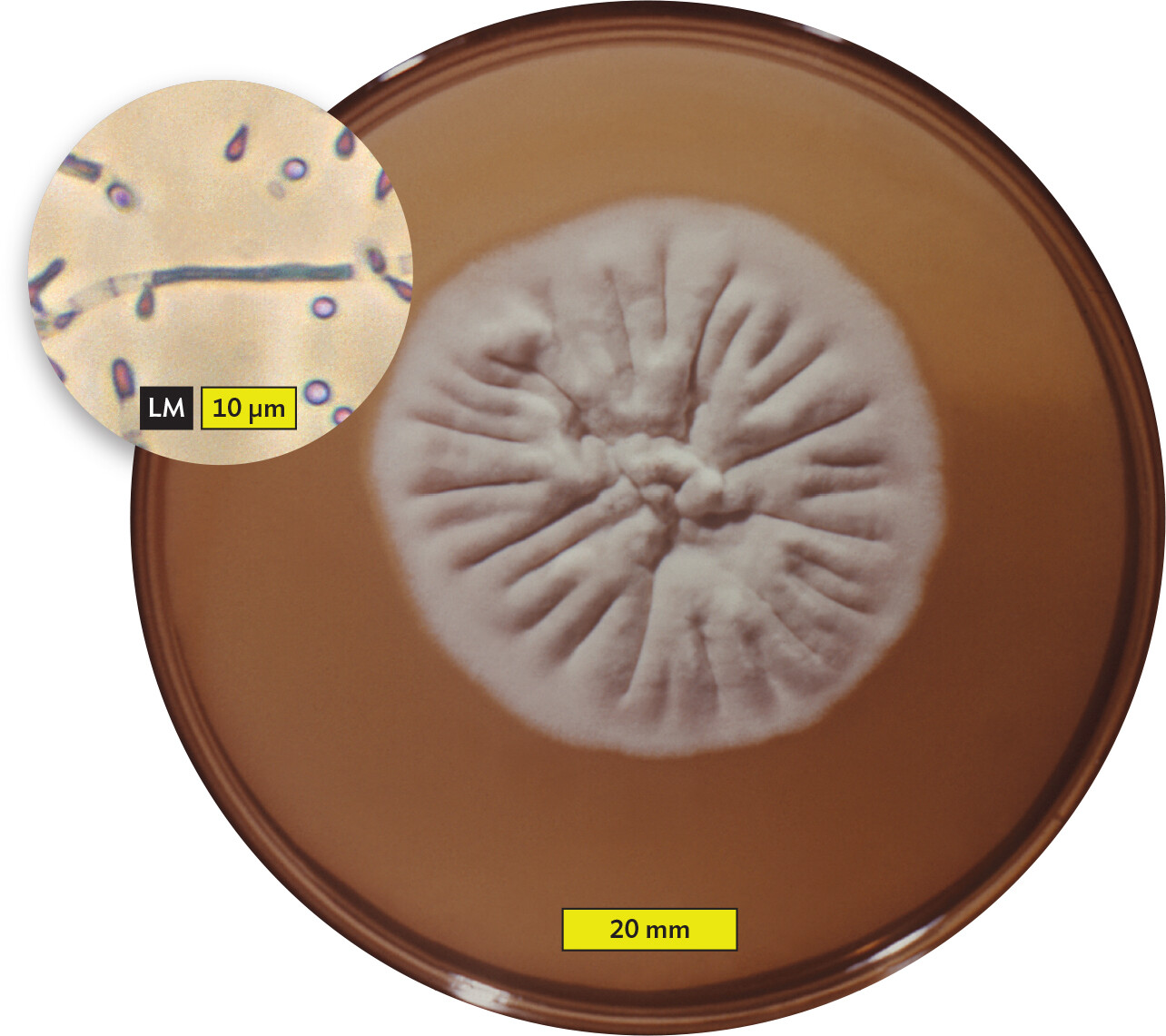 A photo and light micrograph of Trichophyton rubrum.