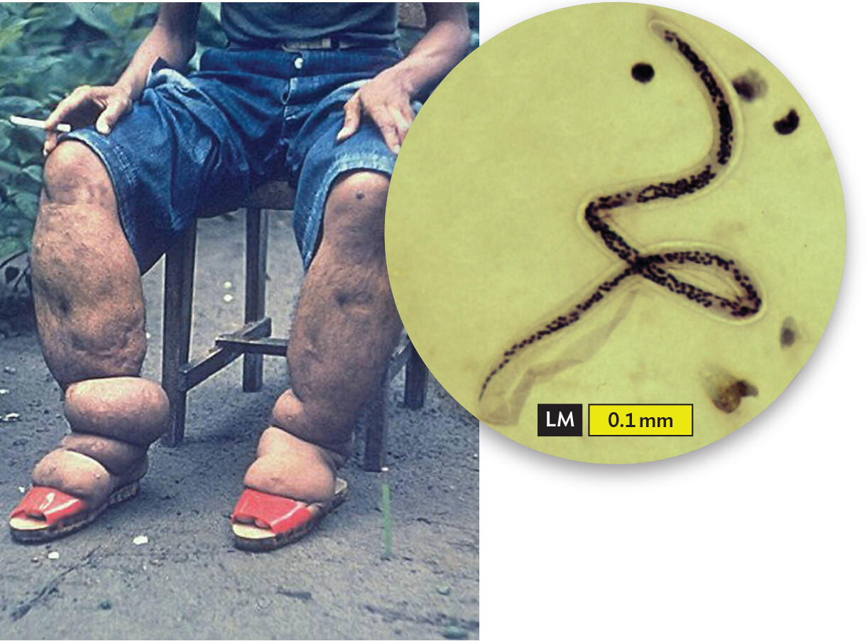 A photo of a patient afflicted with the parasite Wuchereria bancrofti with an inset light micrograph of the parasite.