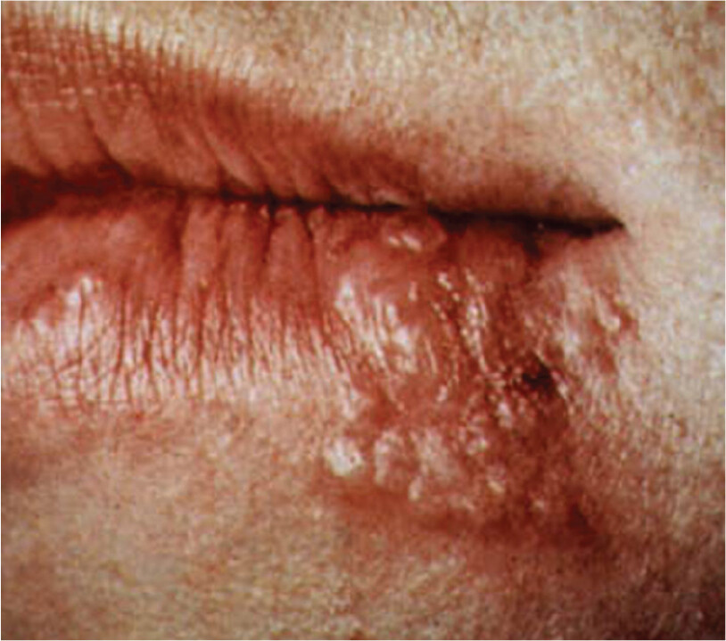A photo of a herpes infection on the lips of a person.
