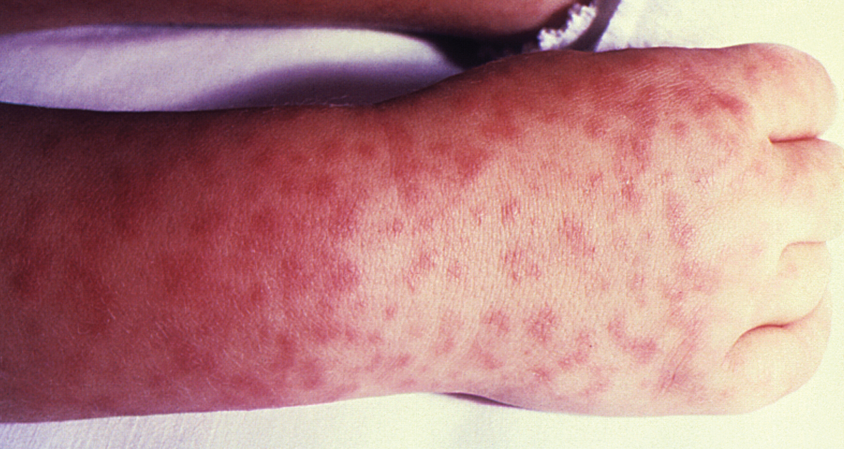 A photo of a hand with a rash related to Rocky Mountain Spotted Fever.
