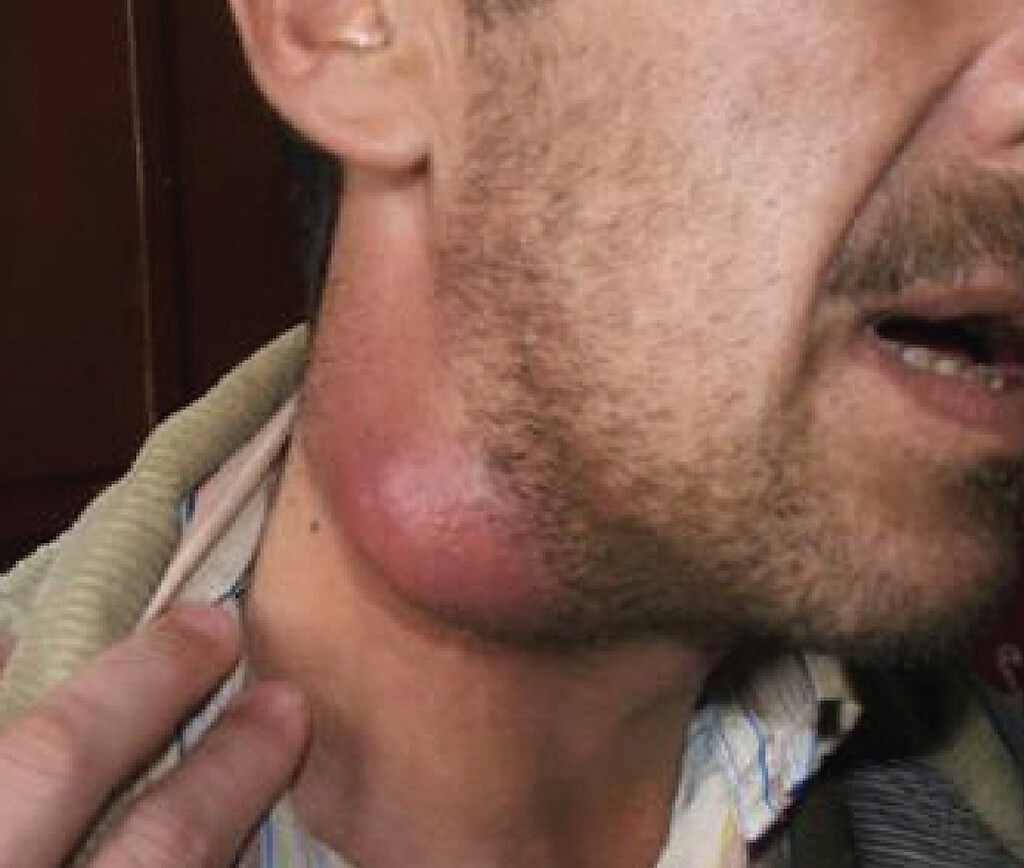 A photo of a severely swollen lymph node in the neck of a patient infected with tularemia.