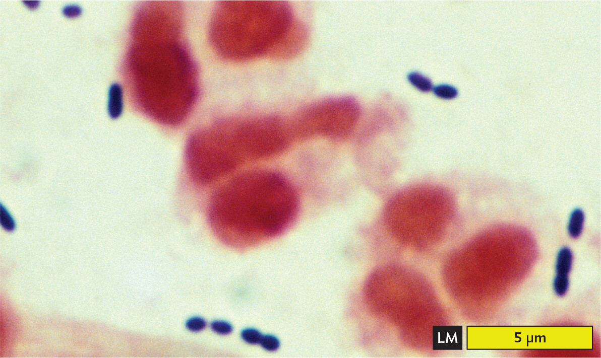 A light micrograph of a gram stained sputum specimen from a patient with pneumonia containing Gram positive cells.
