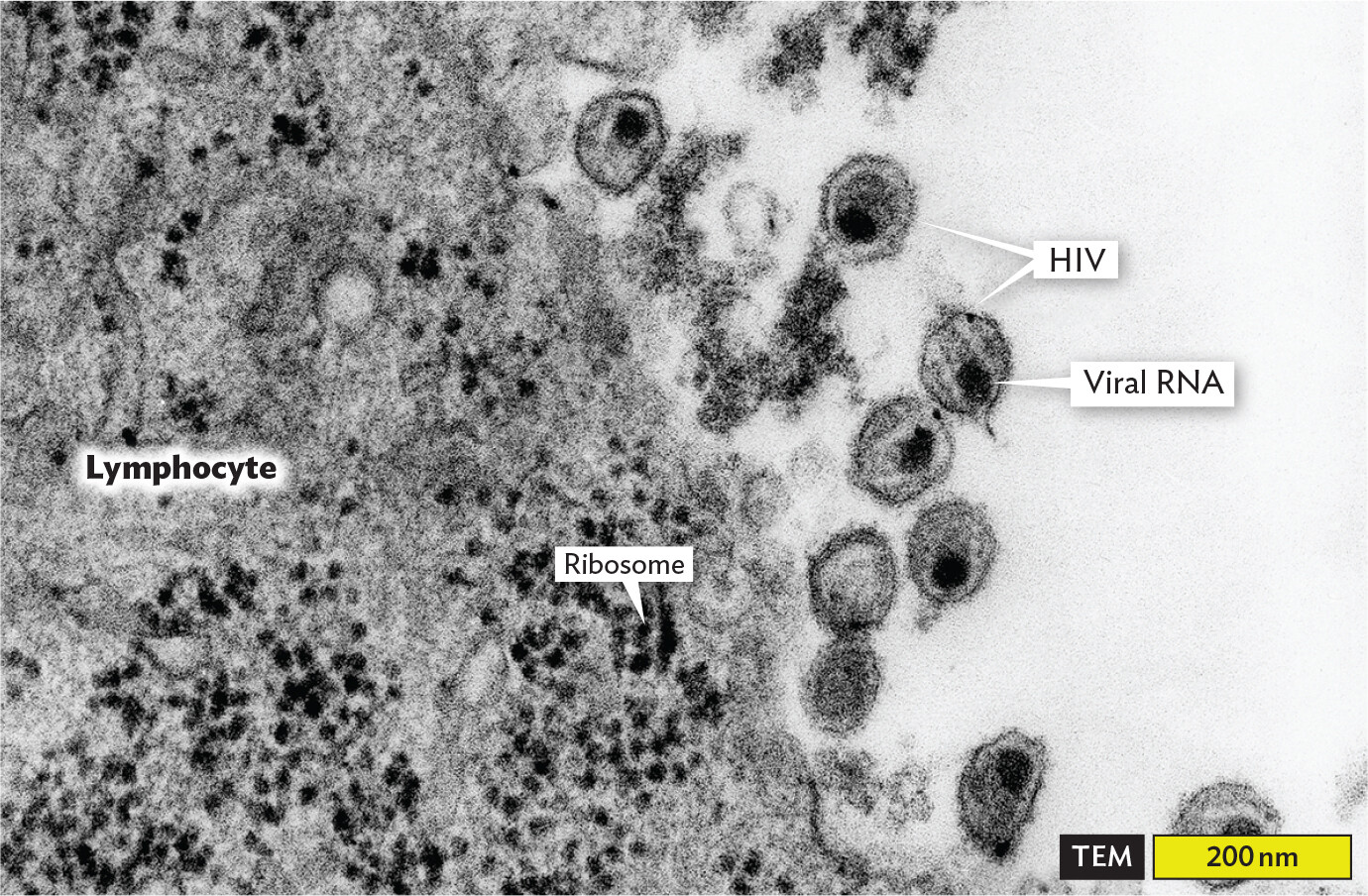 A transmission electron micrograph of H I V particles emerging from an infected lymphocyte.