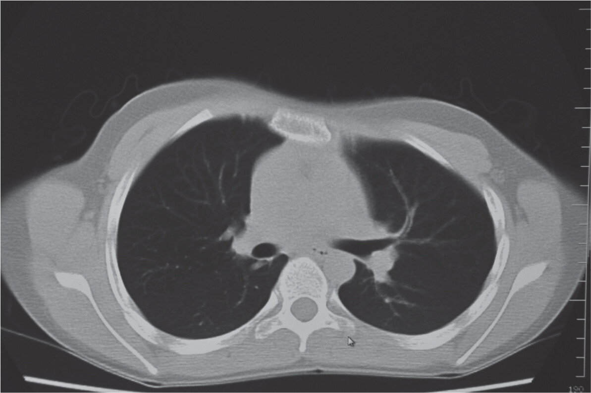 A photo of a chest C T scan of healthy lungs.