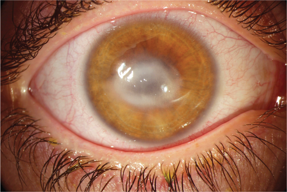 A photo of an Acanthamoeba infection in the eye.