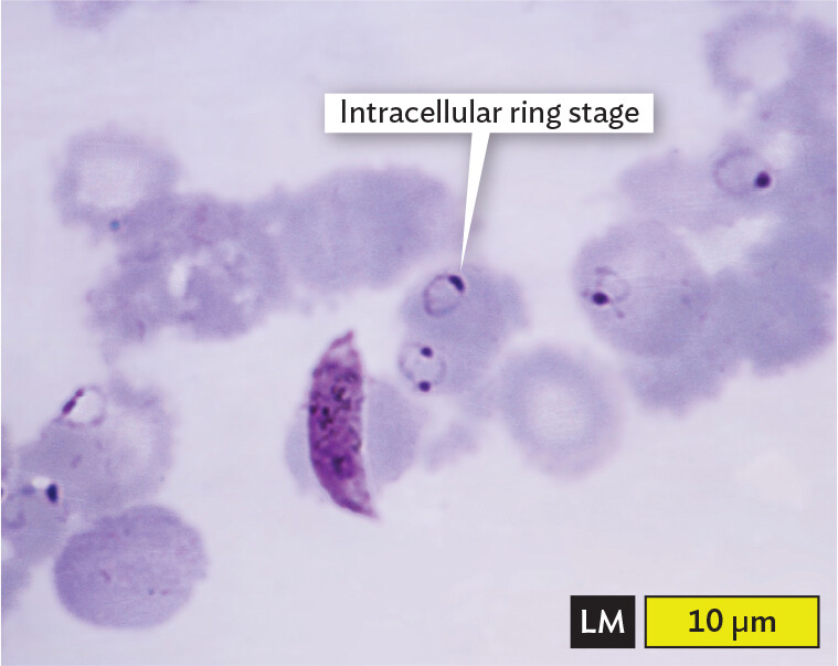 A light micrograph of Red Blood Cells infected by Plasmodium falciparum.