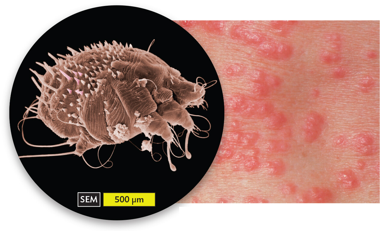 A scanning electron micrograph of Sarcoptes scabiei variant hominis and a photo of a scabies rash.
