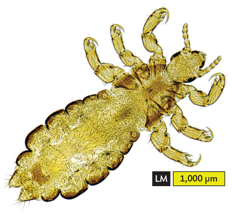 A light micrograph of a head louse.