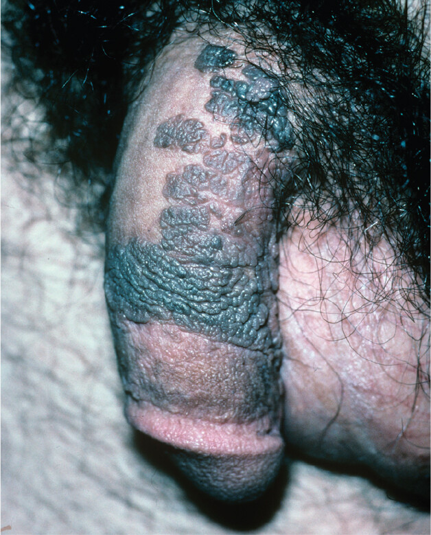 A photo of genital warts, a symptom of certain strains of human papillomavirus infection.