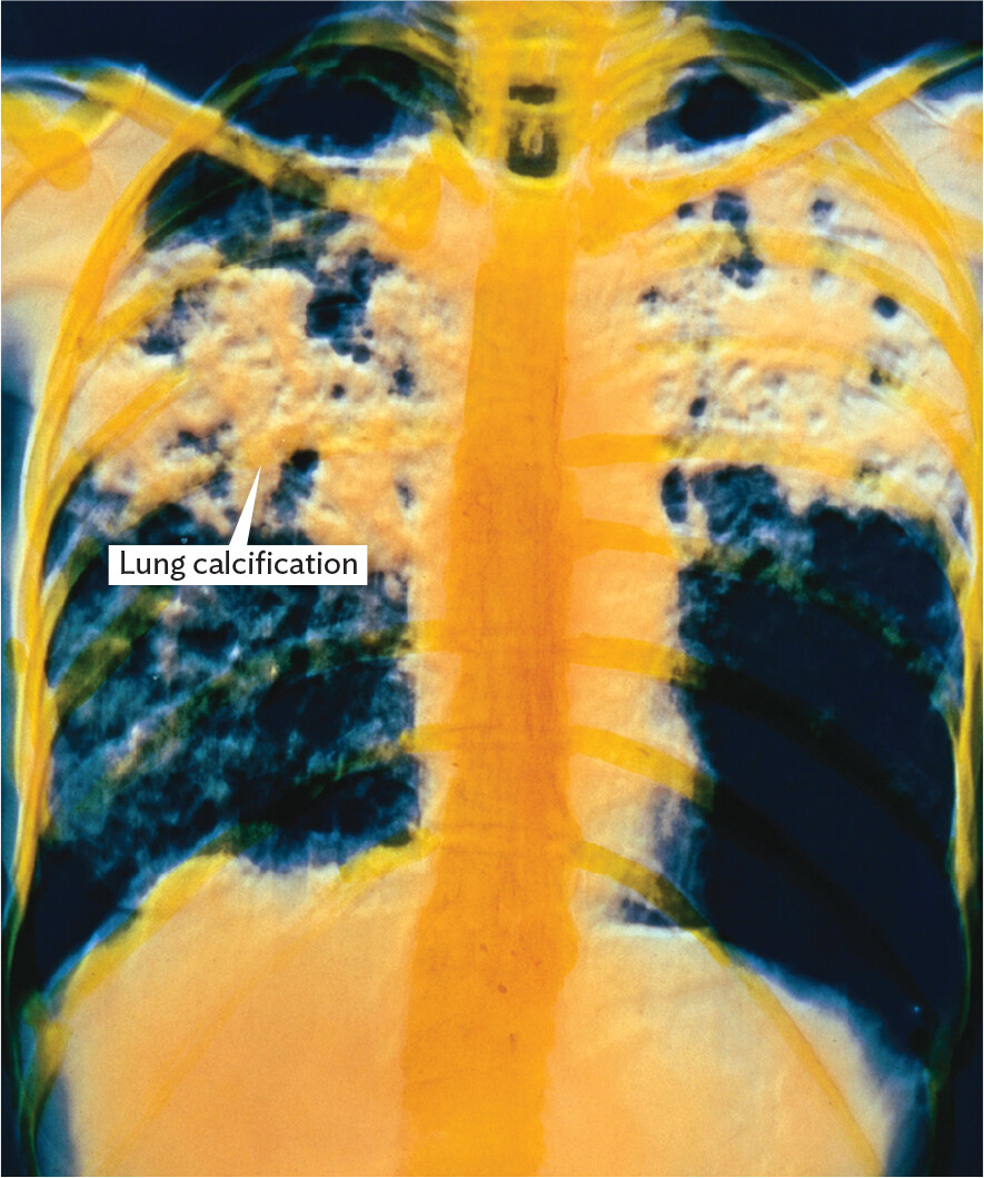 An artificially colored chest x ray showing lung calcifications from tuberculosis.
