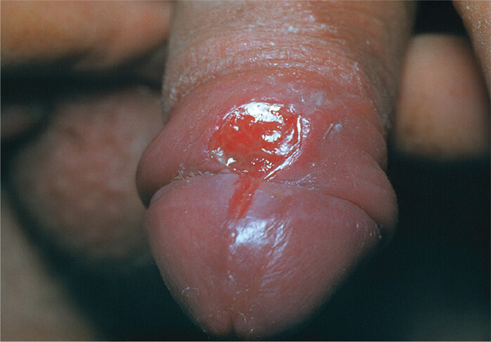 A photo of a syphilis chancre on the foreskin of a human penis.