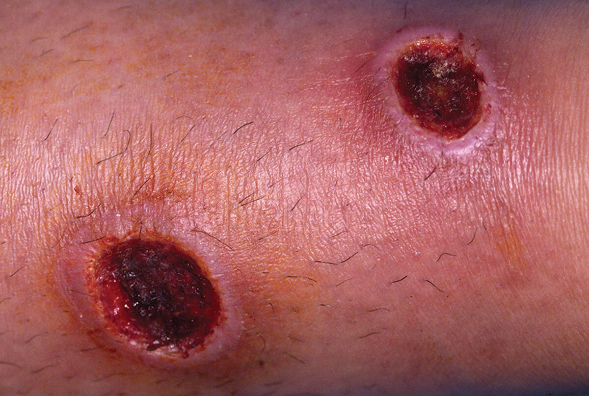 A photo of skin lesions typical of Leishmaniasis.