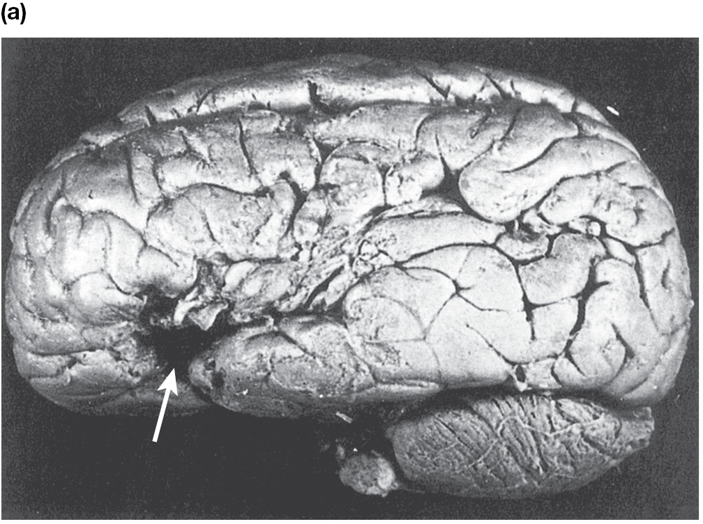 A black-and-white picture of a human brain in which Broca’s area is indicated with an arrow.