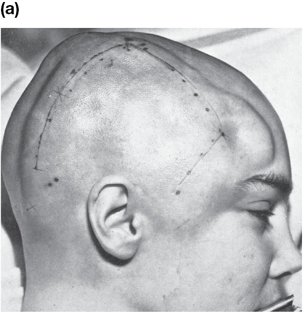 A photo shows a side view of a shaved patient’s head with markings where incisions will be made.