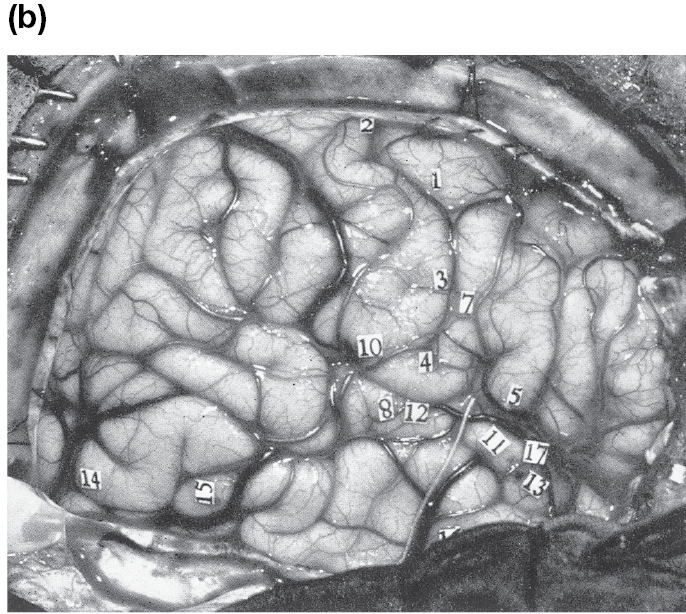 A photo shows the patient’s Cerebral cortex.