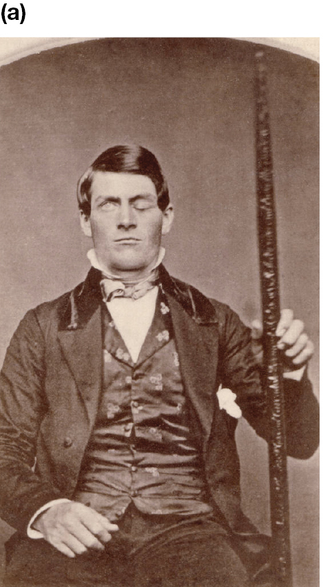 A black and white portrait of Phineas Gage holding a large metal rod. He has a patch over his left eye.