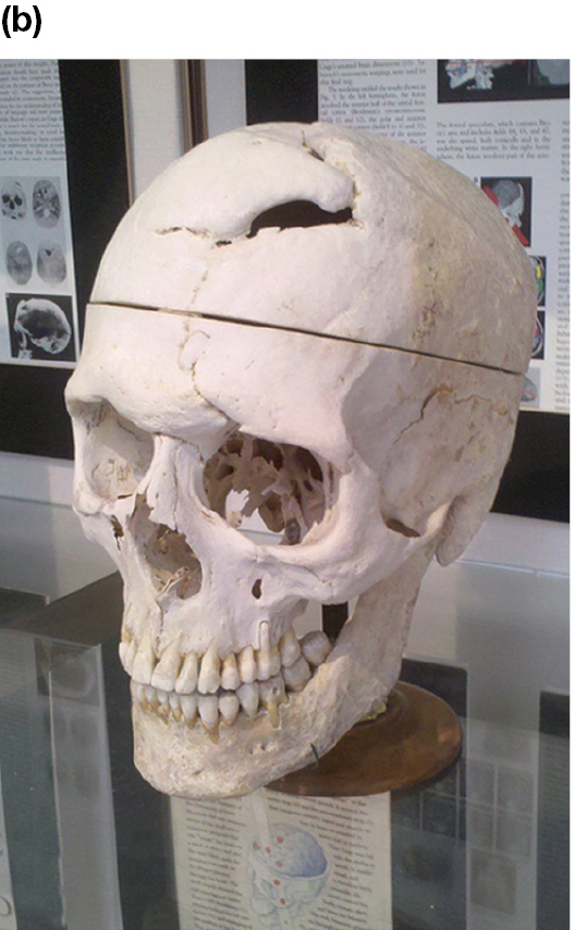 A picture shows Gage’s skull with a large hole in the top front.