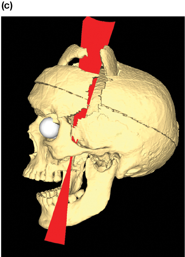 A picture shows a computer-generated image of a human skull with a red rod piercing through it.