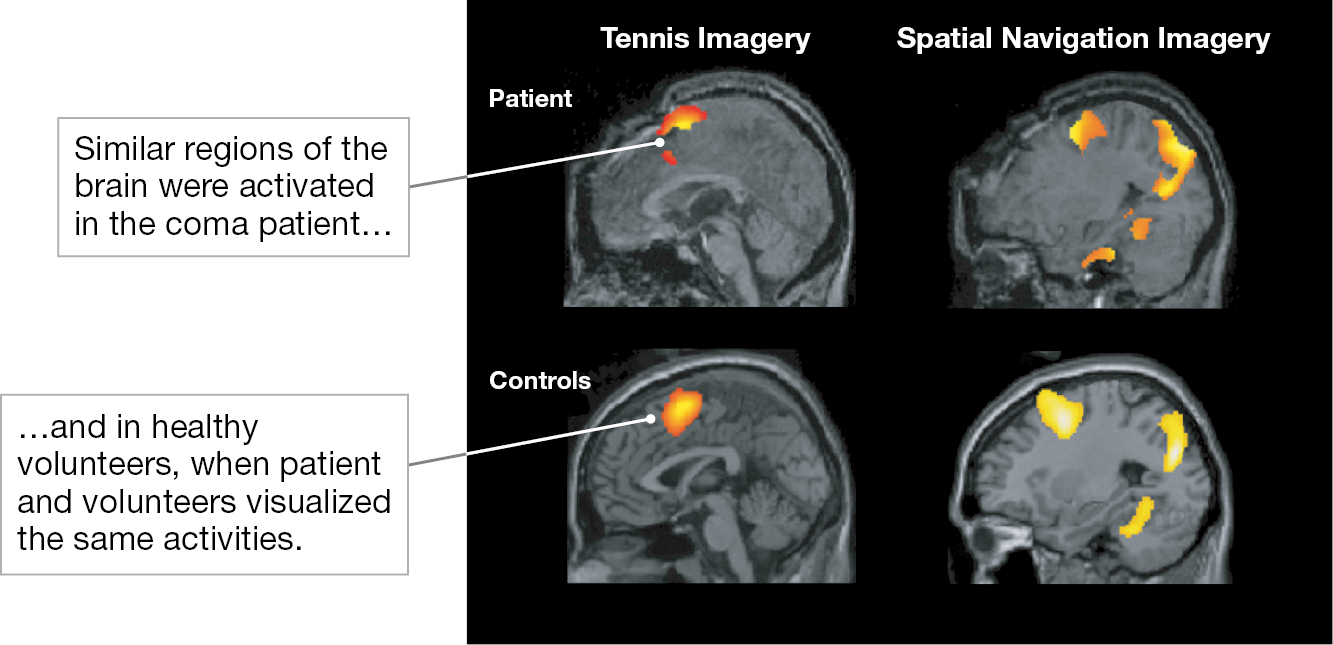 Four images compare the pattern of brain activity of a coma patient and a control group.