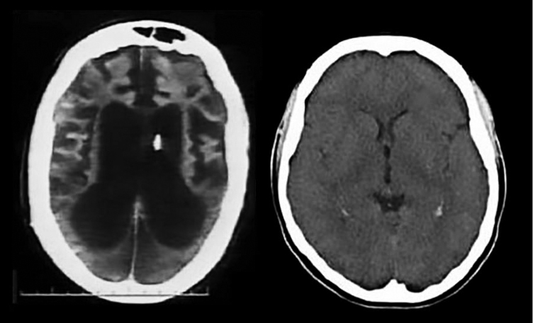 Two brain imaging depicts the activity of the brain which is in a coma state or unconscious state.