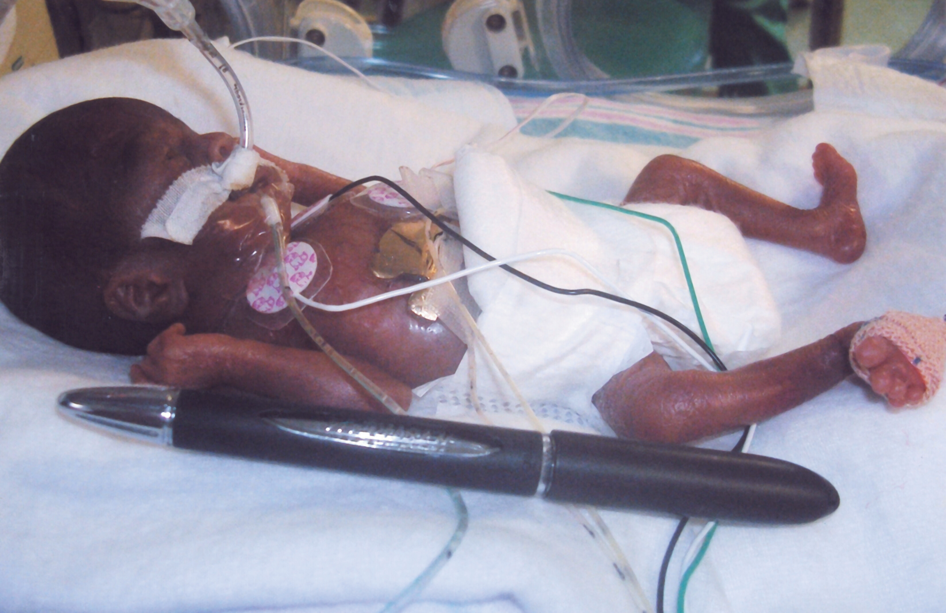 Photo of a premature child who is slightly longer than the ballpoint pen placed next to her.