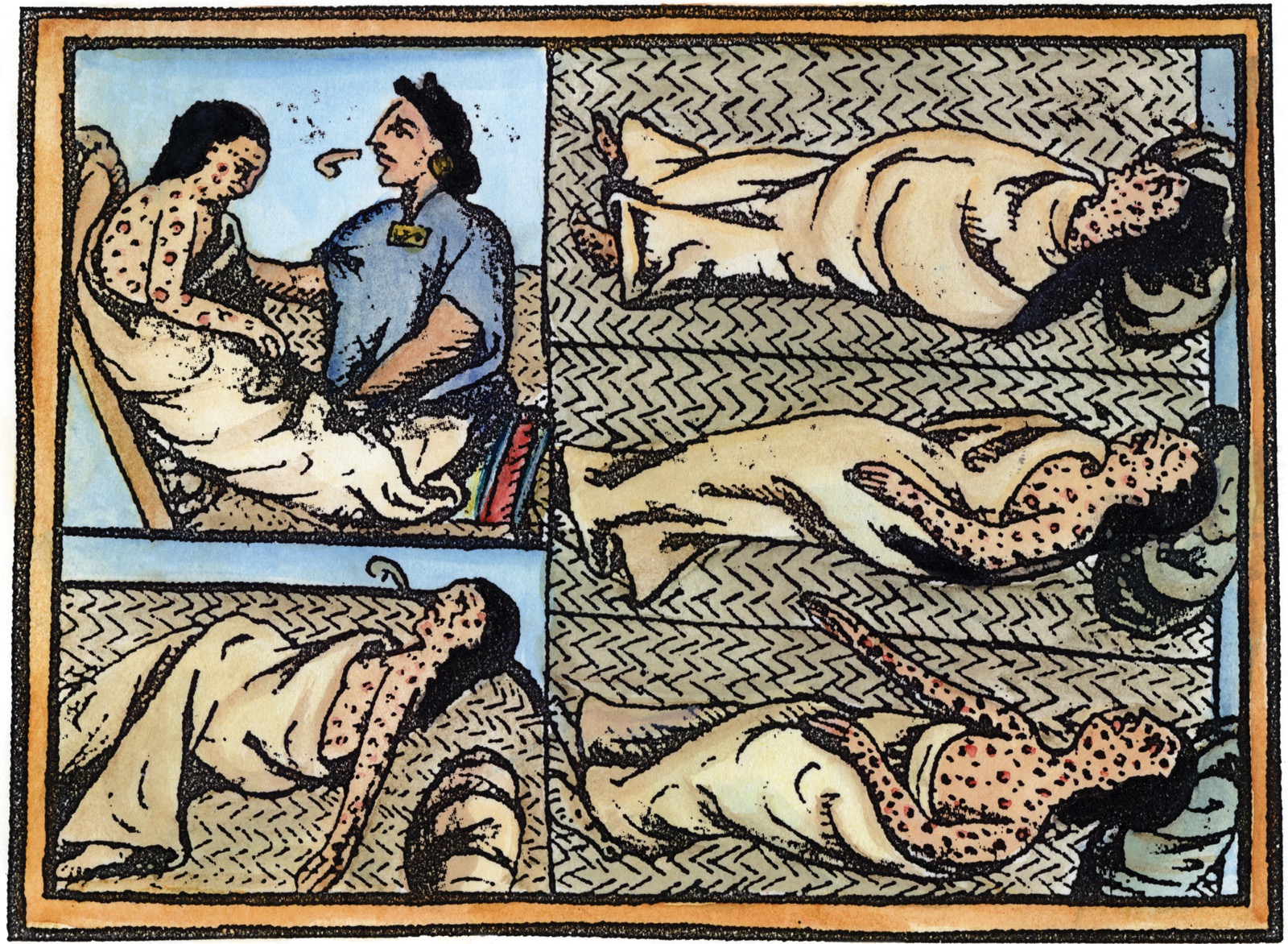 An illustration of five panels, depicts the stages of the death of a smallpox patient.
